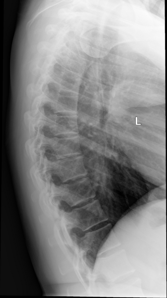 File:Normal thoracic spine (Radiopaedia 40136-42642 Lateral 1).png