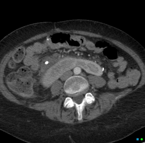 File:Obstructed infected horseshoe kidney (Radiopaedia 18116-17898 B 22).jpg