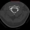 Occipital condyle fracture (Radiopaedia 18366-18208 Axial bone window 26).jpg