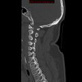 Occipital condyle fracture (Radiopaedia 18366-18208 Sagittal bone window 24).jpg