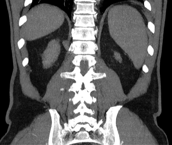 File:Abdominal aortic aneurysm (Radiopaedia 22421-22458 C 38).jpg