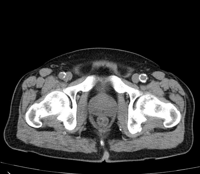File:Abdominal aortic aneurysm (Radiopaedia 22421-22458 non-contrast 56).jpg