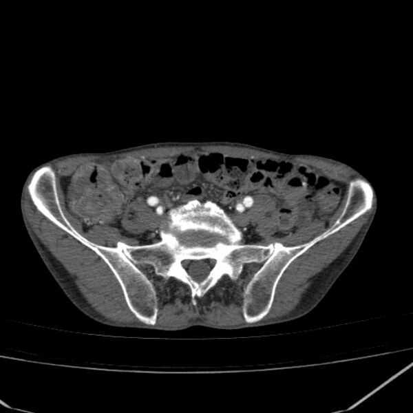 File:Abdominal aortic aneurysm (Radiopaedia 23703-23856 Axial C+ arterial phase 71).jpg