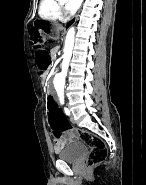 File:Abdominal aortic aneurysm (Radiopaedia 83581-98689 Sagittal C+ arterial phase 51).jpg