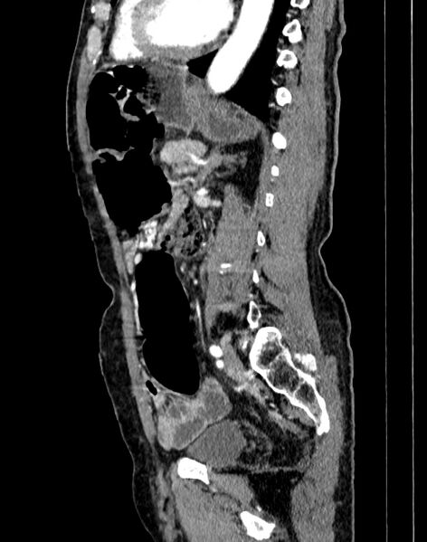 File:Abdominal aortic aneurysm (Radiopaedia 83581-98689 Sagittal C+ arterial phase 68).jpg
