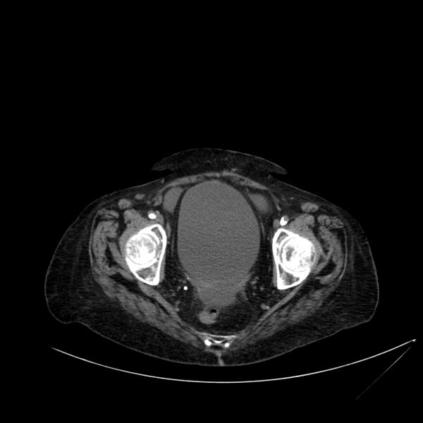 File:Abdominal aortic aneurysm - impending rupture (Radiopaedia 19233-19246 Axial non-contrast 113).jpg