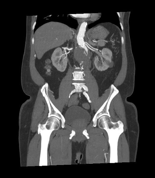 File:Abdominal aortic aneurysm with thrombus fissuration (Radiopaedia 46218-50618 Coronal C+ arterial phase 16).jpg
