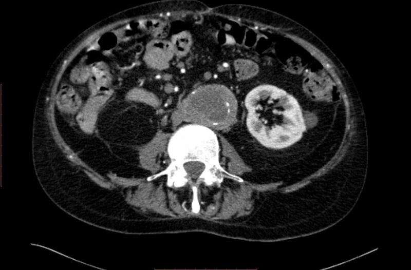 File:Abdominal aortic interposition tube graft and aneurysm thrombosis (Radiopaedia 71438-81857 Axial C+ arterial phase 90).jpg