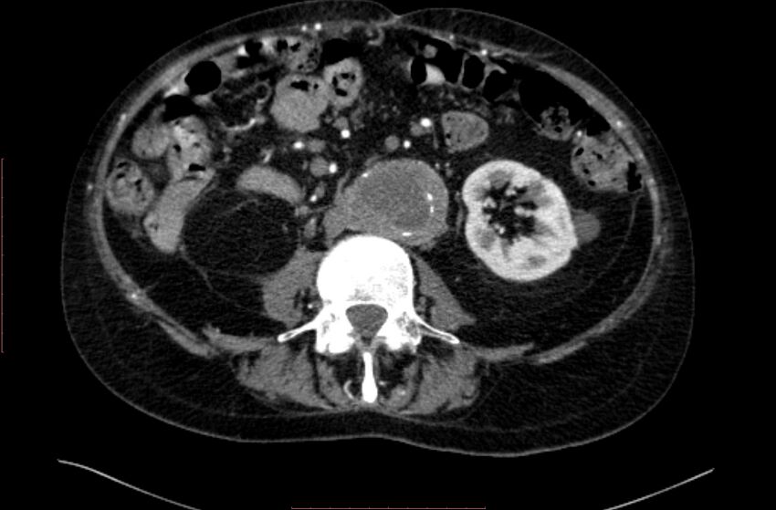 Abdominal aortic interposition tube graft and aneurysm thrombosis (Radiopaedia 71438-81857 Axial C+ arterial phase 90).jpg