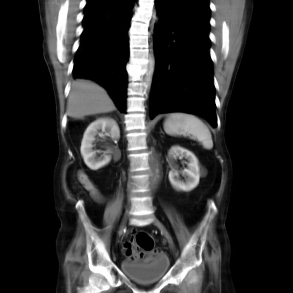 File:Abdominal aortic interposition tube graft and aneurysm thrombosis (Radiopaedia 71438-81857 Curved Coronal C+ arterial phase 2).jpg