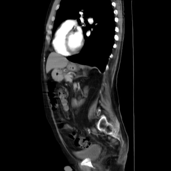 File:Abdominal aortic interposition tube graft and aneurysm thrombosis (Radiopaedia 71438-81857 Curved Sagittal C+ arterial phase 1).jpg
