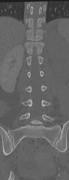 File:Abdominal multi-trauma - devascularised kidney and liver, spleen and pancreatic lacerations (Radiopaedia 34984-36486 Coronal bone window 39).png