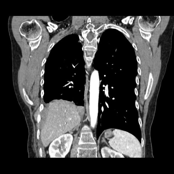 File:Acquired adrenal hyperplasia - due to thymic carcinoid tumor (Radiopaedia 21269-21184 C 8).jpg