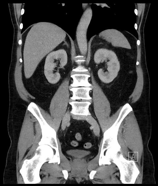 File:Acute-on-chronic pancreatitis (Radiopaedia 67286-76656 Coronal C+ portal venous phase 48).jpg