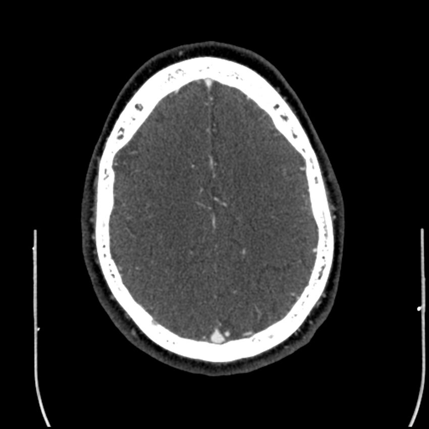 Acute A3 occlusion with ACA ischemic penumbra (CT perfusion) (Radiopaedia 72036-82527 Axial C+ arterial phase thins 1).jpg