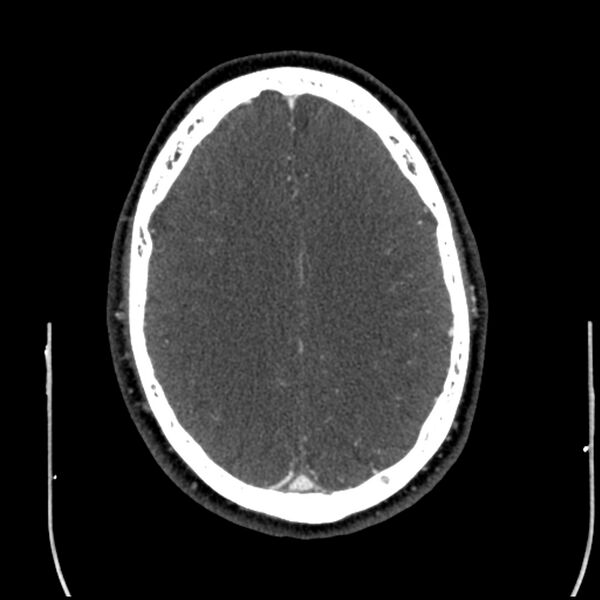 File:Acute A3 occlusion with ACA ischemic penumbra (CT perfusion) (Radiopaedia 72036-82527 Axial C+ arterial phase thins 19).jpg