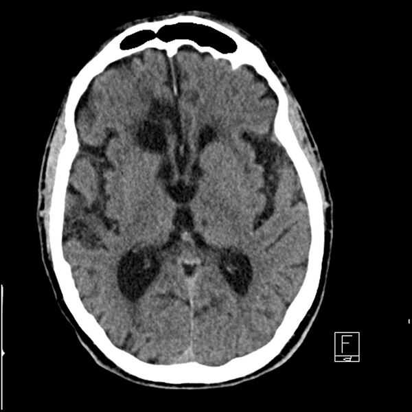 File:Acute ICA ischemic penumbra due to high-grade CCA stenosis (CT perfusion) (Radiopaedia 72038-82529 Axial non-contrast 24).jpg