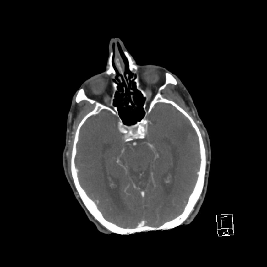Acute ICA ischemic penumbra due to high-grade CCA stenosis (CT perfusion) (Radiopaedia 72038-82530 Axial C+ arterial phase 9).jpg