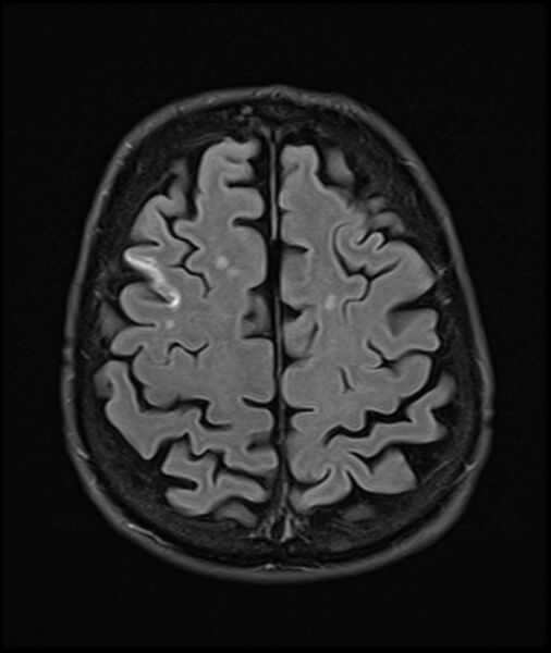 File:Acute P1 occlusion with PCA ischemia penumbra (CT perfusion) (Radiopaedia 72084-82590 Axial FLAIR 30).jpg
