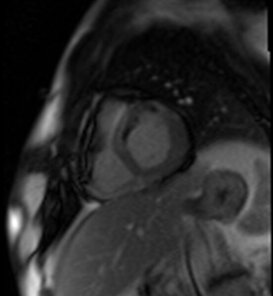 File:Acute anteroseptal myocardial infarction (Radiopaedia 68409-77945 Short axis (basal) Perfusion 49).jpg