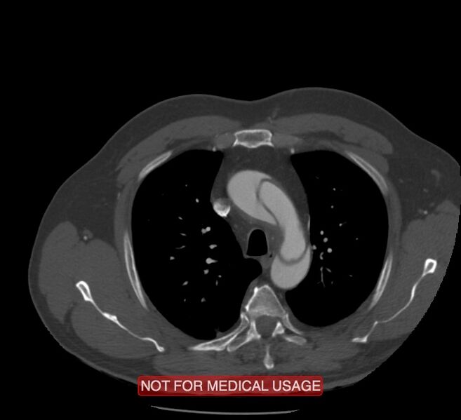 File:Acute aortic dissection - Stanford type A (Radiopaedia 40661-43285 Axial C+ arterial phase 9).jpg