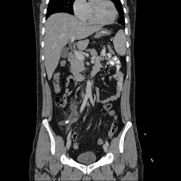 File:Acute appendicitis with appendicoliths (Radiopaedia 21148-21062 Coronal C+ portal venous phase 1).jpg
