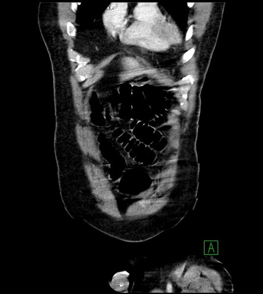 File:Acute arterial mesenteric ischemia (Radiopaedia 78238-90828 Coronal C+ portal venous phase 21).jpg