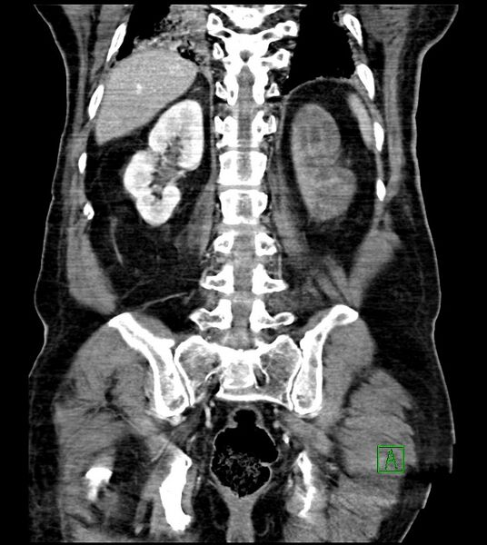 File:Acute arterial mesenteric ischemia (Radiopaedia 78238-90828 Coronal C+ portal venous phase 69).jpg