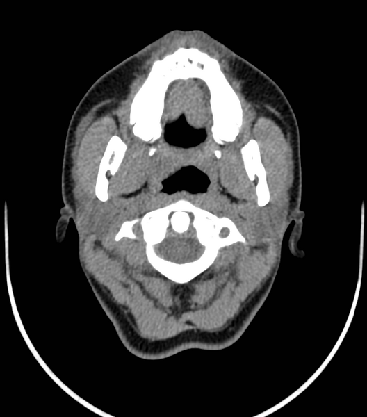 File:Acute bacterial tonsillitis (Radiopaedia 22882-22908 Axial non-contrast 12).png