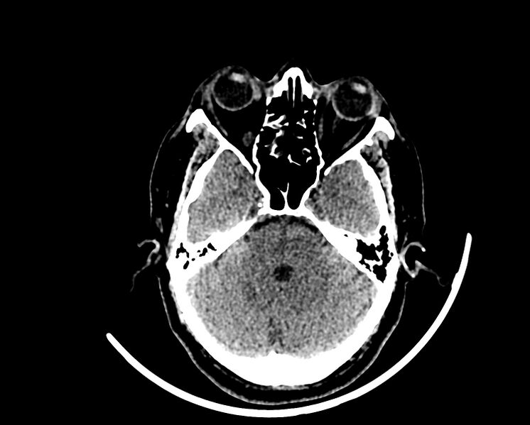 File:Acute cerebral infarct (Radiopaedia 35604-37123 Axial non-contrast 27).jpg