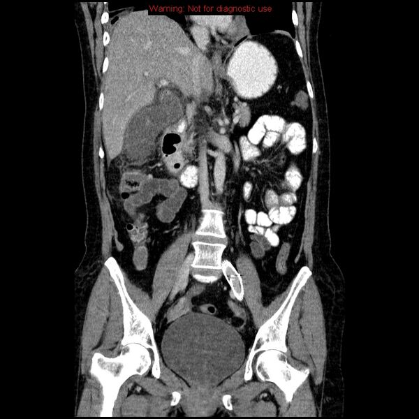 File:Acute gangrenous cholecystitis (Radiopaedia 10123-10661 Coronal C+ portal venous phase 18).jpg