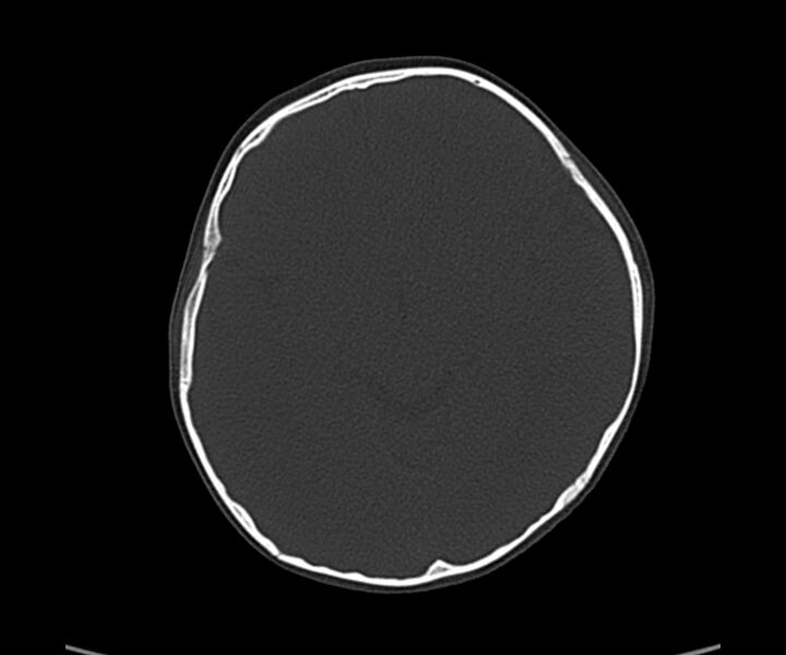 File:Acute hemorrhagic contusion (Radiopaedia 63660-72336 Axial bone window 31).jpg