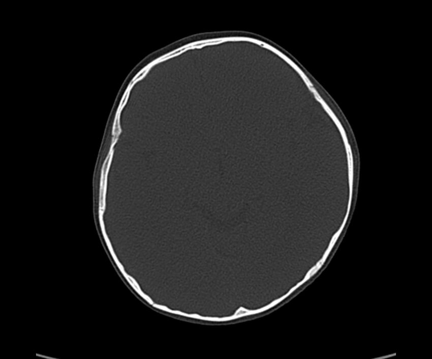 Acute hemorrhagic contusion (Radiopaedia 63660-72336 Axial bone window 31).jpg