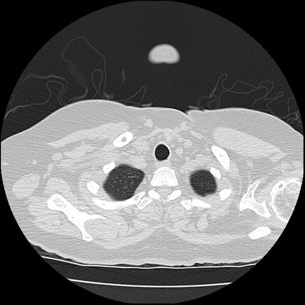 File:Acute interstitial pneumonitis (Radiopaedia 45404-49452 Axial lung window 6).jpg