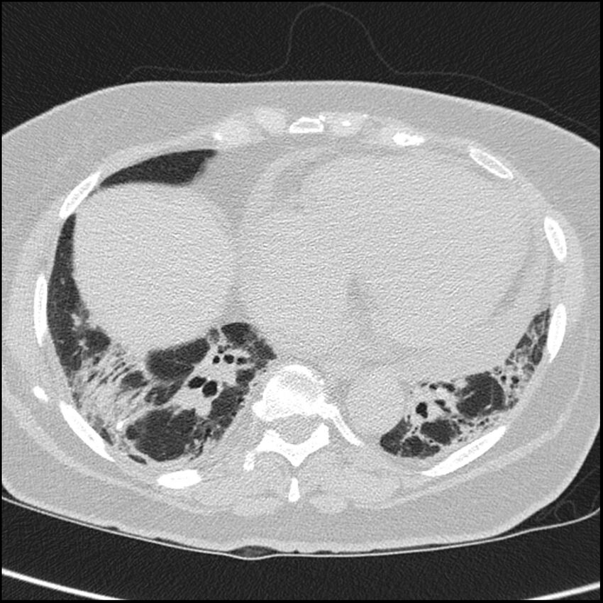 Acute interstitial pneumonitis (Radiopaedia 45404-49453 Axial lung window 57).jpg
