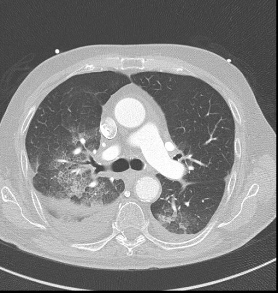 File:Acute myocardial infarction (Radiopaedia 23413-23481 lung window 17).jpg