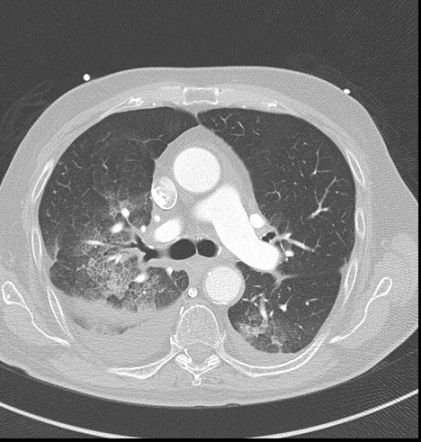 Acute myocardial infarction (Radiopaedia 23413-23481 lung window 17).jpg