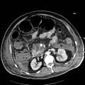 Acute pancreatic necrosis (Radiopaedia 13560-18502 Axial C+ portal venous phase 36).jpg