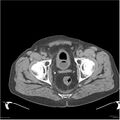 Acute pancreatitis (Radiopaedia 19135-19116 Axial non-contrast 55).jpg