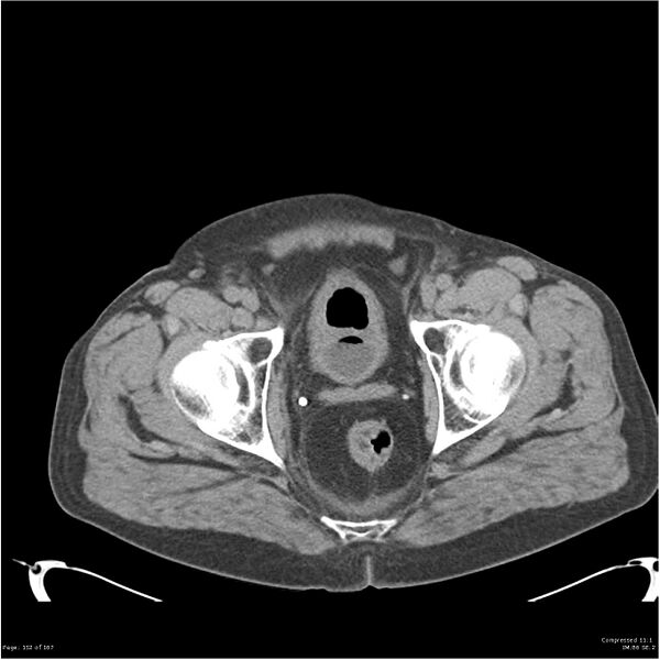 File:Acute pancreatitis (Radiopaedia 19135-19116 Axial non-contrast 55).jpg