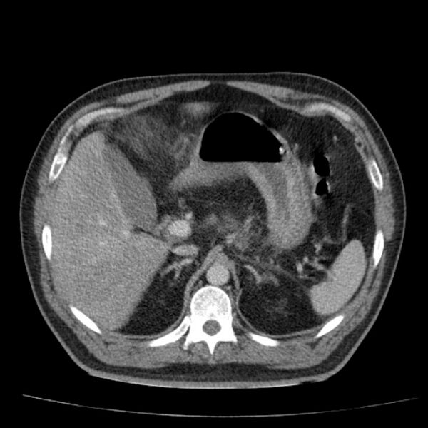 File:Acute pancreatitis (Radiopaedia 26663-26813 Axial C+ portal venous phase 22).jpg