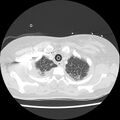 Acute pulmonary edema on CT (Radiopaedia 33582-34672 Axial lung window 5).jpg