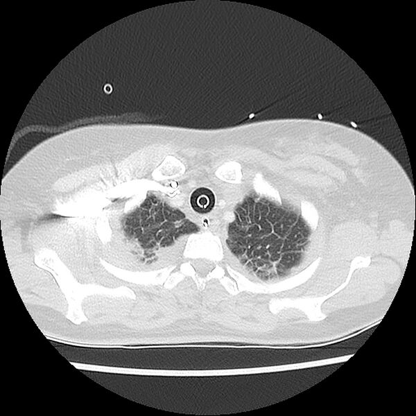 File:Acute pulmonary edema on CT (Radiopaedia 33582-34672 Axial lung window 5).jpg