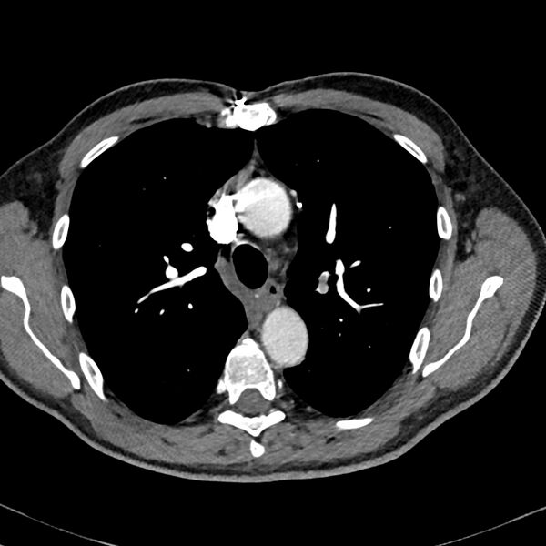 File:Acute pulmonary embolism (Radiopaedia 81677-95570 Axial C+ CTPA 21).jpg