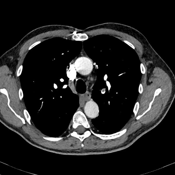 File:Acute pulmonary embolism (Radiopaedia 81677-95570 Axial C+ CTPA 26).jpg