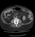Acute renal failure post IV contrast injection- CT findings (Radiopaedia 47815-52557 Axial non-contrast 44).jpg