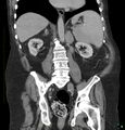 Acute renal failure post IV contrast injection- CT findings (Radiopaedia 47815-52559 Coronal C+ portal venous phase 21).jpg