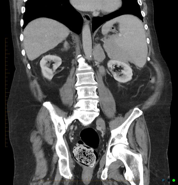 File:Acute renal failure post IV contrast injection- CT findings (Radiopaedia 47815-52559 Coronal C+ portal venous phase 21).jpg