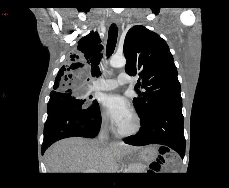 File:Acute right lung abscess (Radiopaedia 34806-36258 Coronal C+ arterial phase 31).jpg
