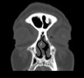 Acute sinusitis (Radiopaedia 23161-23215 Coronal bone window 22).jpg